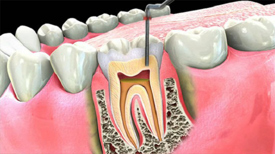 Cost of Root Canal Treatment in Vasant Kunj
