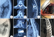 Best Spine Surgeon in Kerala