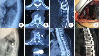 Best Spine Surgeon in Kerala