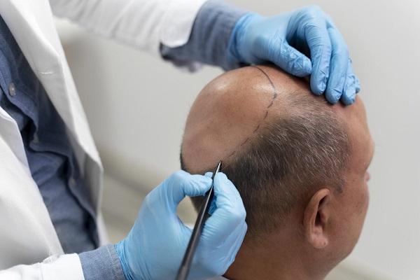 Hair Transplant Clinic in Kolkata​