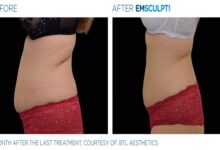 Best Treatment for Fat Loss