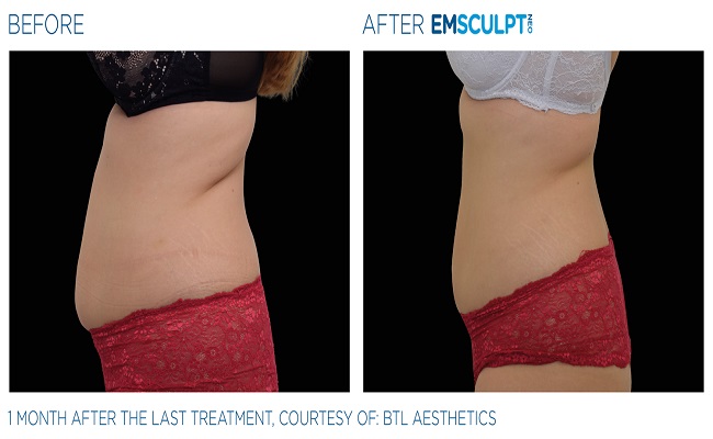 Best Treatment for Fat Loss